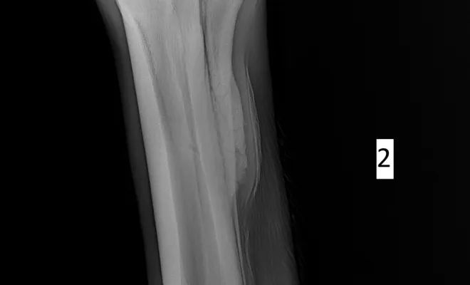 Radiographie de contrôle 7 semaines plus tard